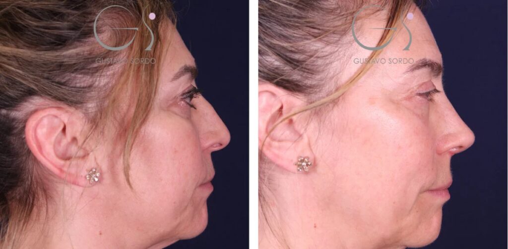 Rhinoplastie : avant et après une intervention réalisée à Madrid