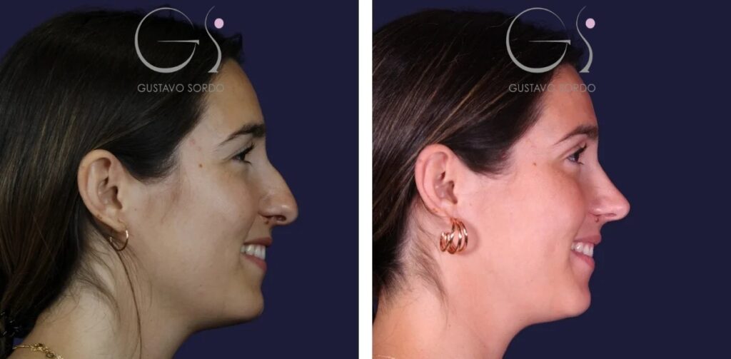 Rhinoplastie : avant et après une intervention réalisée à Madrid