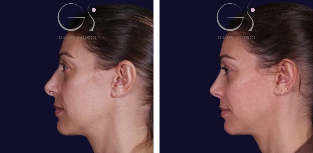 Rhinoplastie : avant et après une intervention réalisée à Madrid