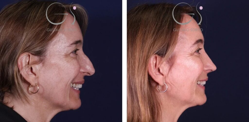 Rhinoplastie : avant et après une intervention réalisée à Madrid
