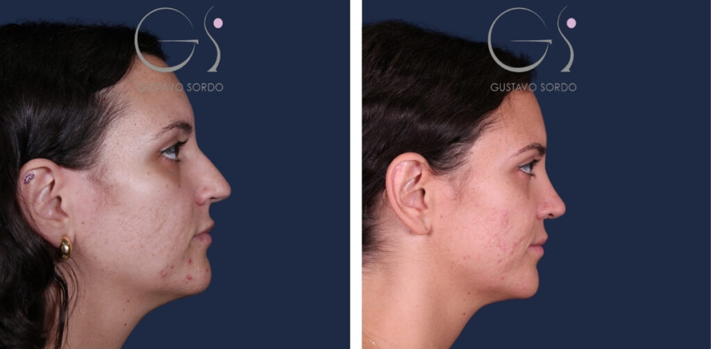 Rhinoplastie — nez droit, résultat naturel&nbsp;: avant et après une intervention réalisée à Madrid