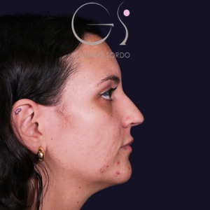 Rinoplastia recta natural, antes de la cirugía — caso operado por el Dr. Gustavo Sordo en Madrid (6)