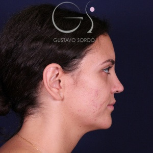 Rinoplastia recta natural, resultado tras la cirugía — caso operado por el Dr. Gustavo Sordo en Madrid (6)