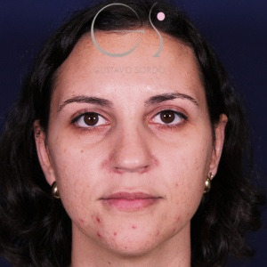 Rinoplastia recta natural, antes de la cirugía — caso operado por el Dr. Gustavo Sordo en Madrid (1)