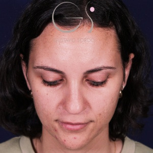 Rinoplastia recta natural, antes de la cirugía — caso operado por el Dr. Gustavo Sordo en Madrid (2)