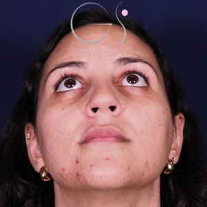 Rinoplastia recta natural, antes de la cirugía — caso operado por el Dr. Gustavo Sordo en Madrid (3)