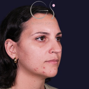 Rinoplastia recta natural, antes de la cirugía — caso operado por el Dr. Gustavo Sordo en Madrid (4)