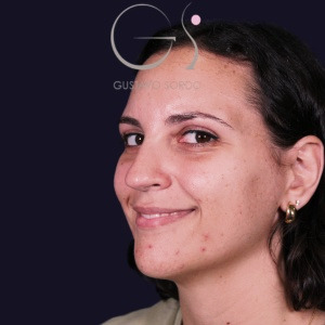 Rinoplastia recta natural, antes de la cirugía — caso operado por el Dr. Gustavo Sordo en Madrid (5)