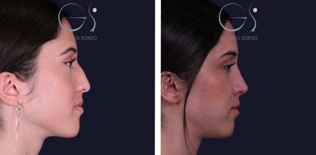 Rhinoplastie — nez droit, résultat naturel&nbsp;: avant et après une intervention réalisée à Madrid