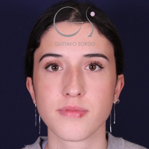Rinoplastia mujer recta natural, antes de la cirugía — caso operado por el Dr. Gustavo Sordo en Madrid (1)