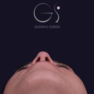 Rinoplastia mujer recta natural, resultado tras la cirugía — caso operado por el Dr. Gustavo Sordo en Madrid (3)