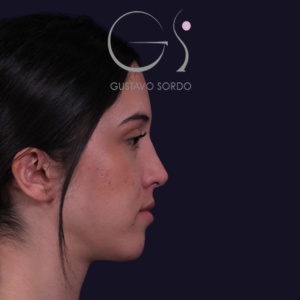 Rinoplastia mujer recta natural, resultado tras la cirugía — caso operado por el Dr. Gustavo Sordo en Madrid (5)