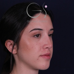 Rinoplastia mujer recta natural, resultado tras la cirugía — caso operado por el Dr. Gustavo Sordo en Madrid (7)