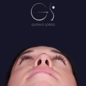 Rinoplastia mujer recta natural, antes de la cirugía — caso operado por el Dr. Gustavo Sordo en Madrid (3)