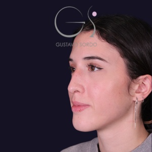 Rinoplastia mujer recta natural, antes de la cirugía — caso operado por el Dr. Gustavo Sordo en Madrid (6)