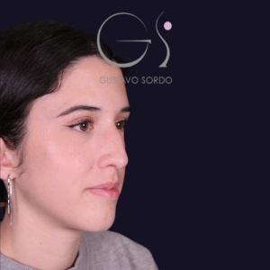 Rinoplastia mujer recta natural, antes de la cirugía — caso operado por el Dr. Gustavo Sordo en Madrid (7)