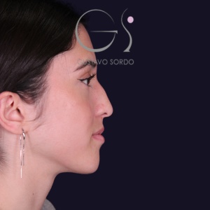 Rinoplastia mujer recta natural, antes de la cirugía — caso operado por el Dr. Gustavo Sordo en Madrid (5)