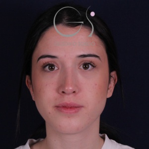 Rinoplastia mujer recta natural, resultado tras la cirugía — caso operado por el Dr. Gustavo Sordo en Madrid (1)