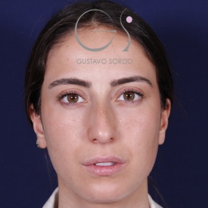 Rinoplastia: dorso recto y resultado natural en mujer - antes, vista frontal. Caso operado por el Dr. Gustavo Sordo en Madrid