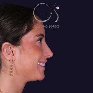 Rinoplastia: dorso recto y resultado natural en mujer - despues, perfil derecho. Caso operado por el Dr. Gustavo Sordo en Madrid