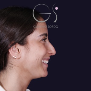 Rinoplastia: dorso recto y resultado natural en mujer - antes, perfil derecho. Caso operado por el Dr. Gustavo Sordo en Madrid