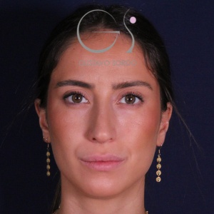 Rinoplastia: dorso recto y resultado natural en mujer - despues, vista frontal. Caso operado por el Dr. Gustavo Sordo en Madrid