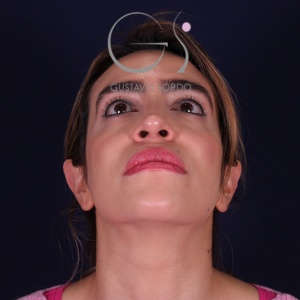 Rinoplastia mujer punta caída, resultado tras la cirugía — caso operado por el Dr. Gustavo Sordo en Madrid (3)