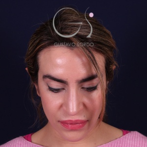 Rinoplastia mujer punta caída, resultado tras la cirugía — caso operado por el Dr. Gustavo Sordo en Madrid (2)