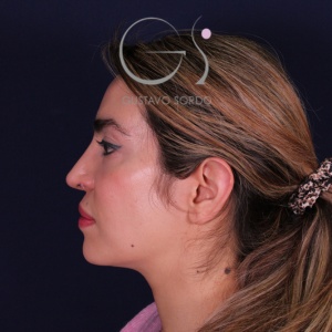 Rinoplastia mujer punta caída, resultado tras la cirugía — caso operado por el Dr. Gustavo Sordo en Madrid (5)