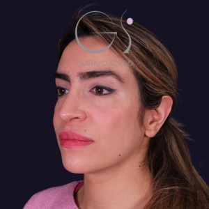 Rinoplastia mujer punta caída, resultado tras la cirugía — caso operado por el Dr. Gustavo Sordo en Madrid (8)