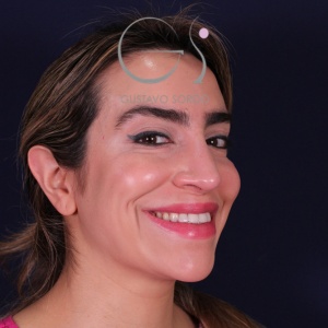 Rinoplastia mujer punta caída, resultado tras la cirugía — caso operado por el Dr. Gustavo Sordo en Madrid (7)