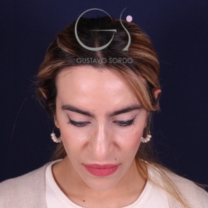 Rinoplastia mujer punta caída, antes de la cirugía — caso operado por el Dr. Gustavo Sordo en Madrid (2)