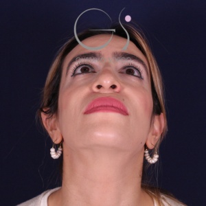 Rinoplastia mujer punta caída, antes de la cirugía — caso operado por el Dr. Gustavo Sordo en Madrid (3)