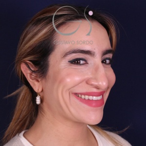 Rinoplastia mujer punta caída, antes de la cirugía — caso operado por el Dr. Gustavo Sordo en Madrid (7)