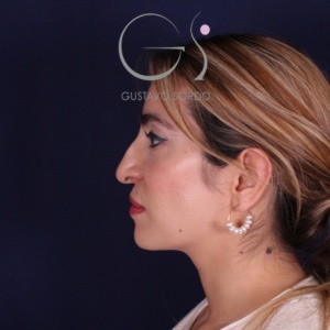 Rinoplastia mujer punta caída, antes de la cirugía — caso operado por el Dr. Gustavo Sordo en Madrid (5)