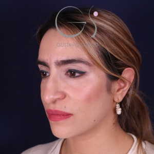 Rinoplastia mujer punta caída, antes de la cirugía — caso operado por el Dr. Gustavo Sordo en Madrid (8)