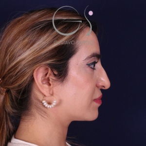 Rinoplastia mujer punta caída, antes de la cirugía — caso operado por el Dr. Gustavo Sordo en Madrid (6)