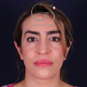 Rinoplastia mujer punta caída, resultado tras la cirugía — caso operado por el Dr. Gustavo Sordo en Madrid (1)