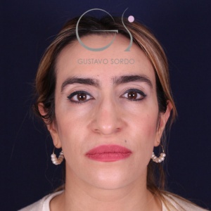 Rinoplastia mujer punta caída, antes de la cirugía — caso operado por el Dr. Gustavo Sordo en Madrid (1)