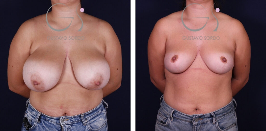 Breast reduction: before and after a case operated on in Madrid