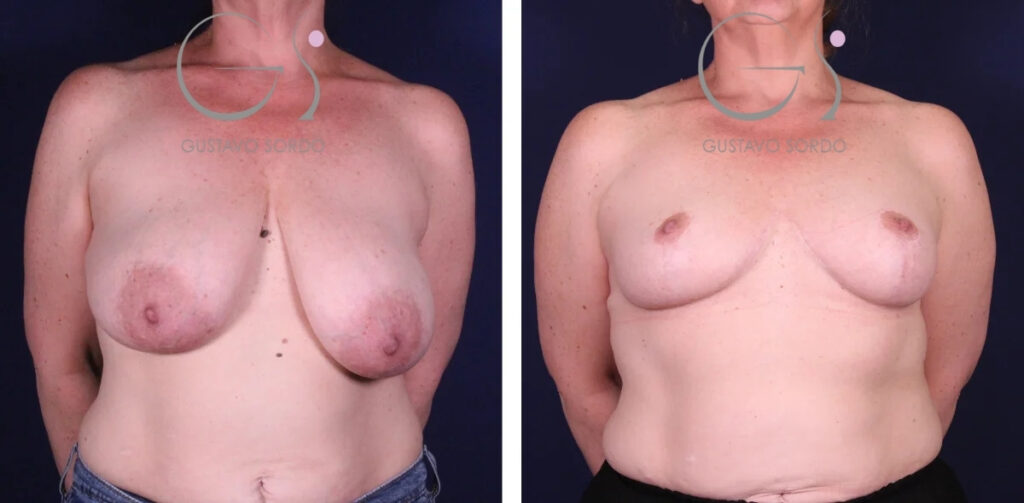 Breast reduction: before and after a case operated on in Madrid