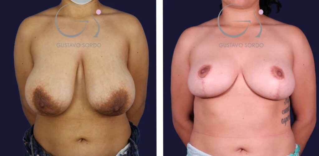 Breast reduction: before and after a case operated on in Madrid