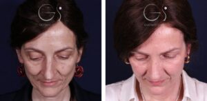 Rinoplastia — nariz aguileña: antes y después de un caso operado en Madrid
