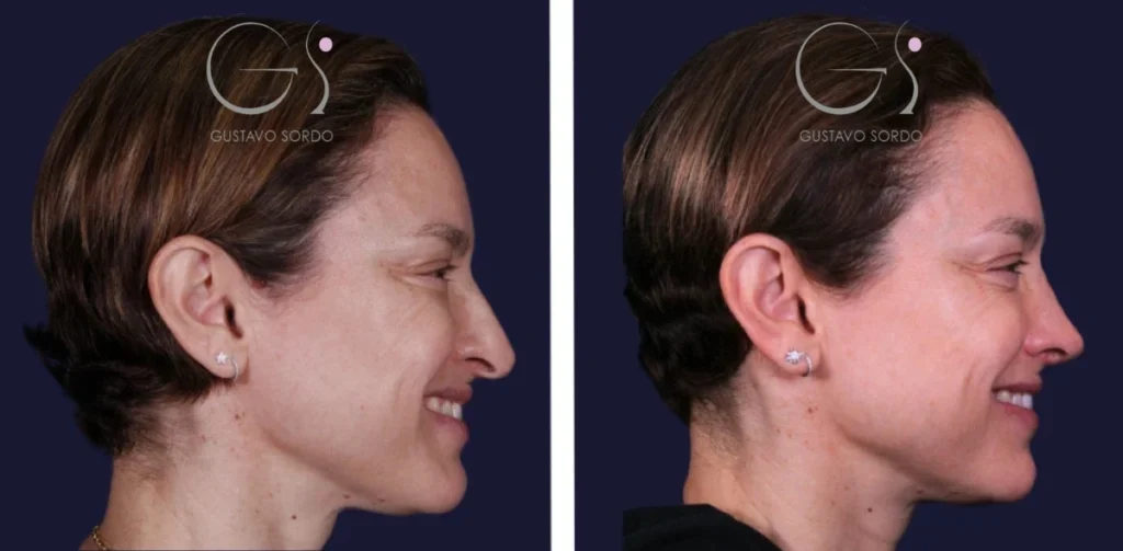 Rinoplastia — caso secundario: antes y después de un caso operado en Madrid