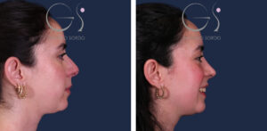 Rinoplastia con resultado natural: antes y después de un caso operado en Madrid