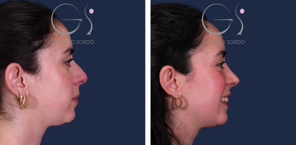 Rinoplastia con resultado natural, sin nariz estandarizada: antes y después