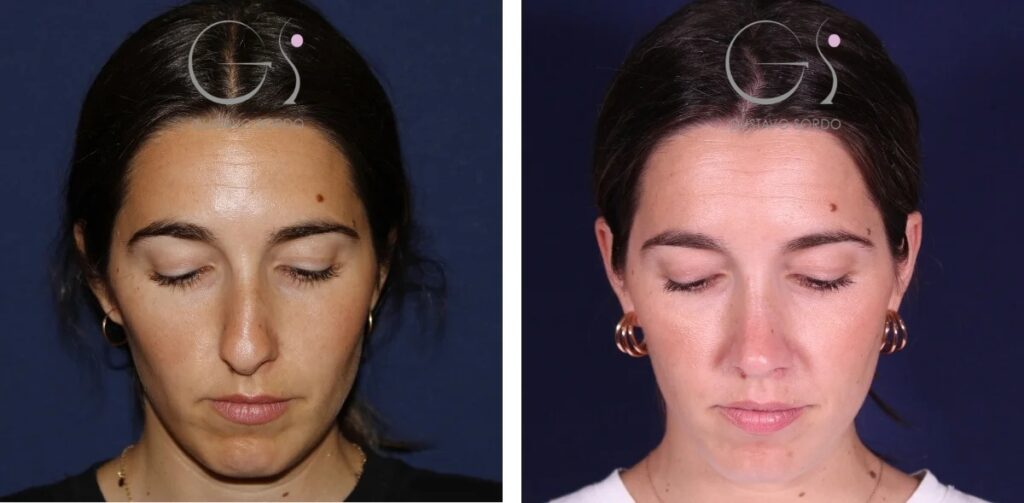 Rhinoplastie — déviation de la cloison nasale&nbsp;: avant et après une intervention réalisée à Madrid