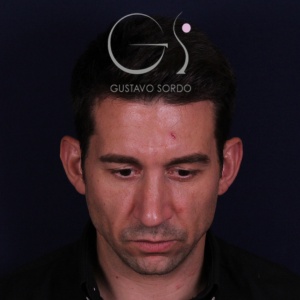 Preservación, resultado tras la cirugía — caso operado por el Dr. Gustavo Sordo en Madrid (2)