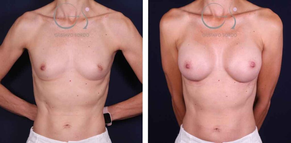 Aumento de pecho — prótesis de 270 cc, prótesis redondas: antes y después de un caso operado en Madrid