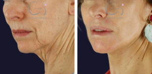 Lifting facial en Madrid